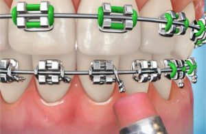 Help! What Do I Do About A Poking Wire? - Hamer & Glassick Orthodontics